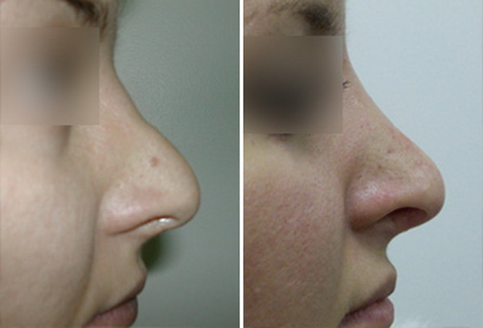 Фото до и после: пластика носа - Галерея 3